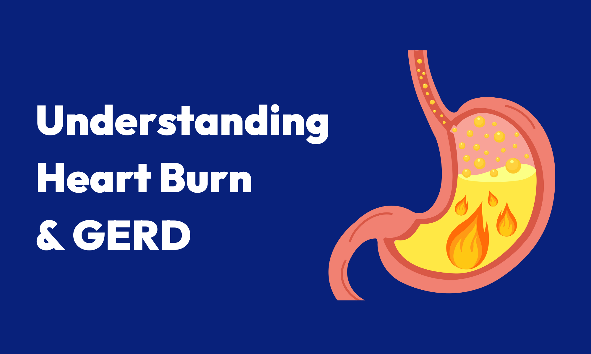 Heartburn amp GERD Understanding the Burning Truth Gastro Star Texas