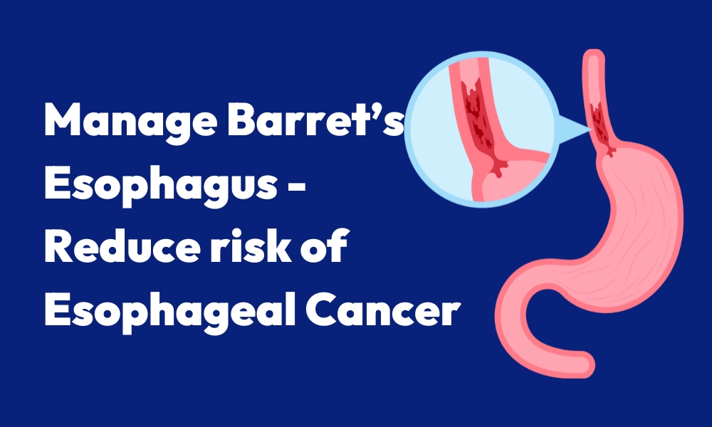 How to Manage Barrett’s Esophagus and Reduce Your Risk of Esophageal Cancer.